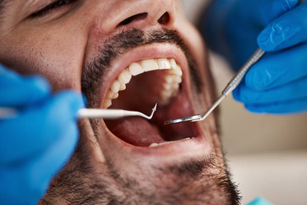 Best Knocked-Out Tooth (Avulsed Tooth) Treatment in Crossville, TN